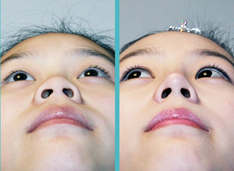 Thu gọn cánh mũi có làm mũi cao hơn không? thu gọn cánh mũi có làm mũi cao hơn không