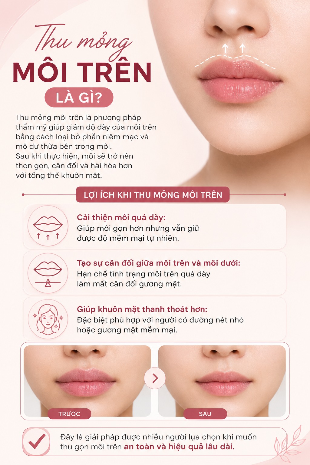 Thu mỏng môi trên là gì?