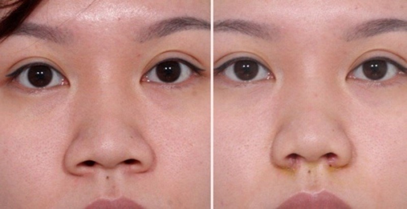 Thu nhỏ cánh mũi Có nên thu nhỏ cánh mũi không?