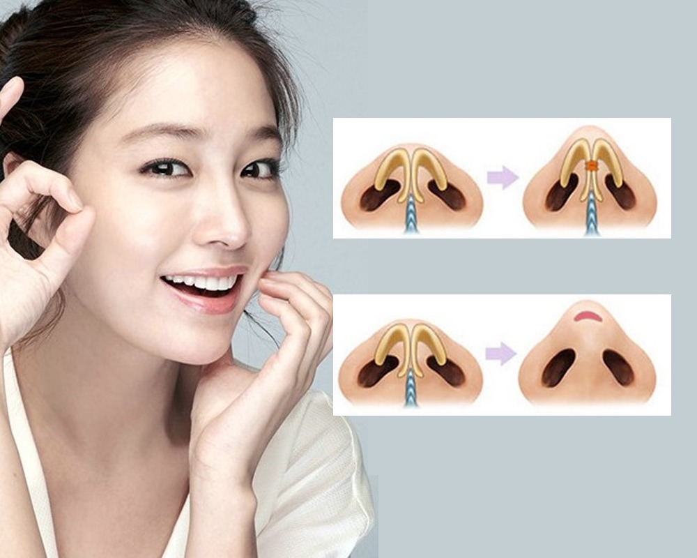 Thu nhỏ đầu mũi là gì? Thu nhỏ đầu mũi