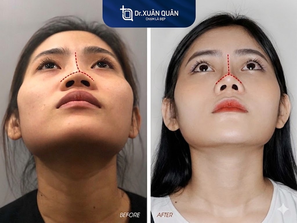 nâng mũi bị sưng một bên