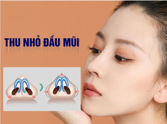 Thu nhỏ đầu mũi có vĩnh viễn không