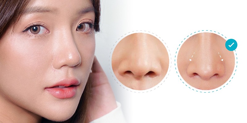 Is nose tip reduction permanent? Answers from a cosmetic surgeon Thu nhỏ đầu mũi có vĩnh viễn không