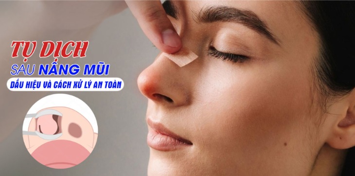 Dấu hiệu tụ dịch sau nâng mũi thường gặp