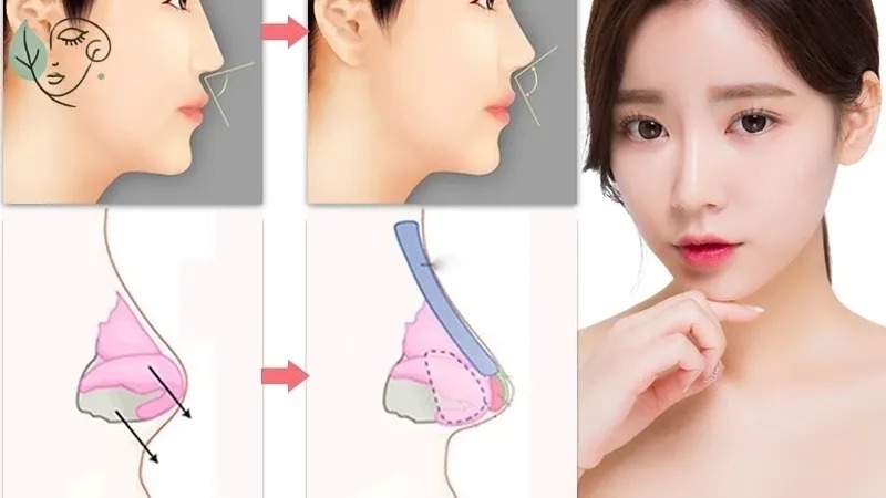 Nâng mũi có được vĩnh viễn không? Yếu tố quyết định tuổi thọ của nâng mũi tuổi thọ của nâng mũi