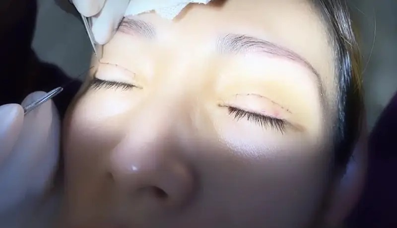 Redness after eyelid surgery: Causes and effective solutions Thông tin vết cắt mí bị đỏ