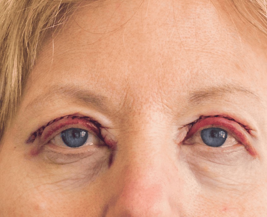 Redness after eyelid surgery: Causes and effective solutions Nguyên nhân vết cắt mí bị đỏ