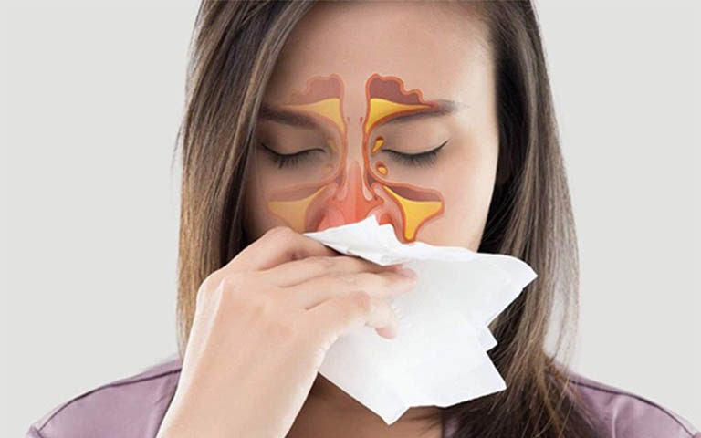 Can someone with allergic rhinitis get a nose job? viêm mũi dị ứng có nâng mũi được không