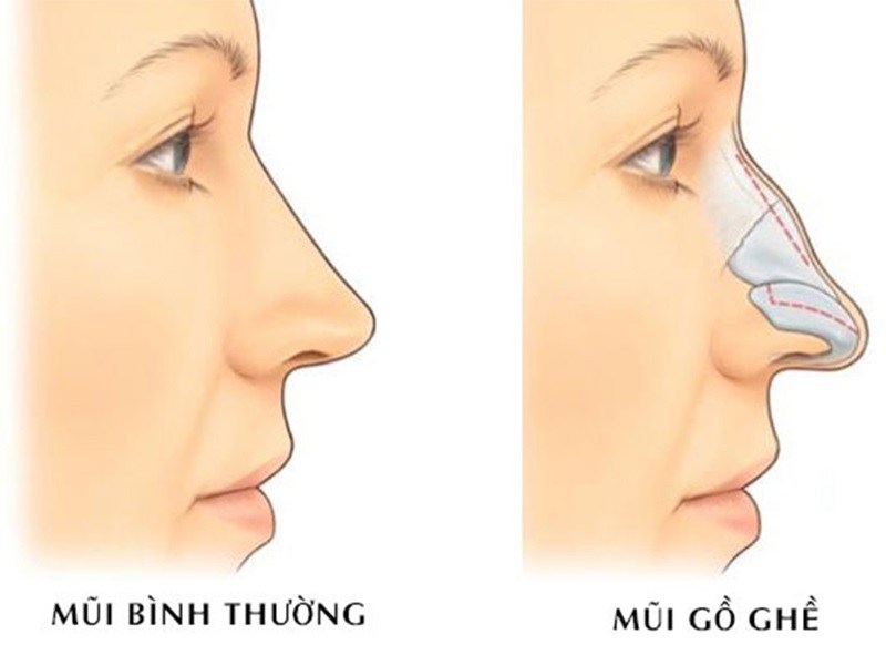 Mài gồ xương mũi xương mũi bình thường và xương mũi gồ