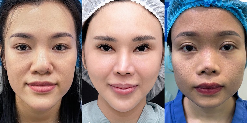 7+ bài tập thu nhỏ cánh mũi tại nhà đơn giản, dễ thực hiện Đến Thẩm mỹ Dr Xuân Quân để được tư vấn