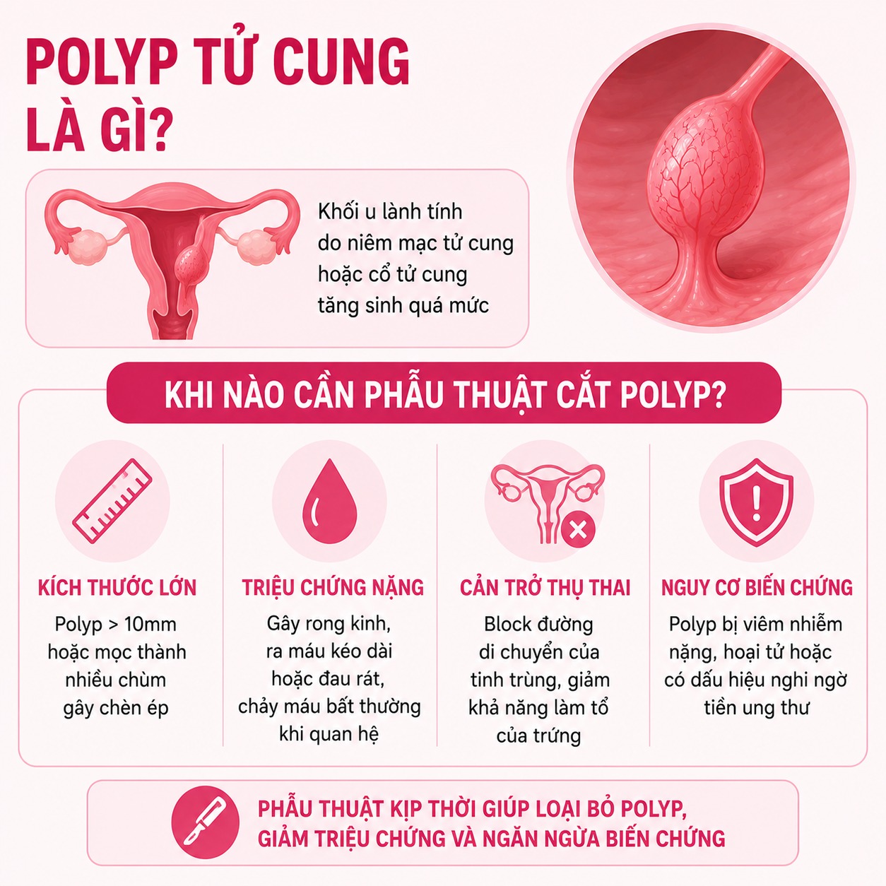 Bóc polyp tử cung Polyp tử cung là gì?