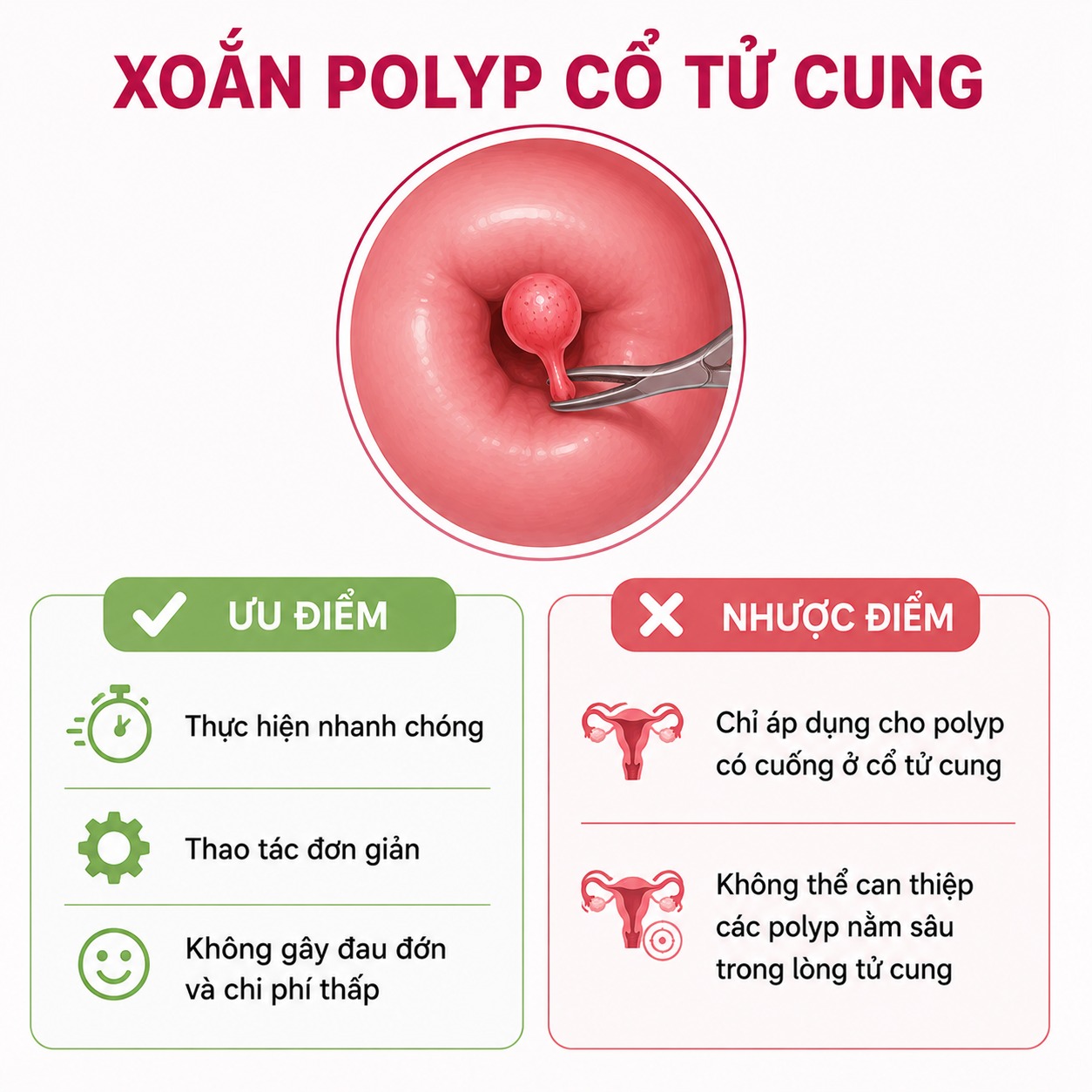 Bóc polyp tử cung Xoắn polyp cổ tử cung