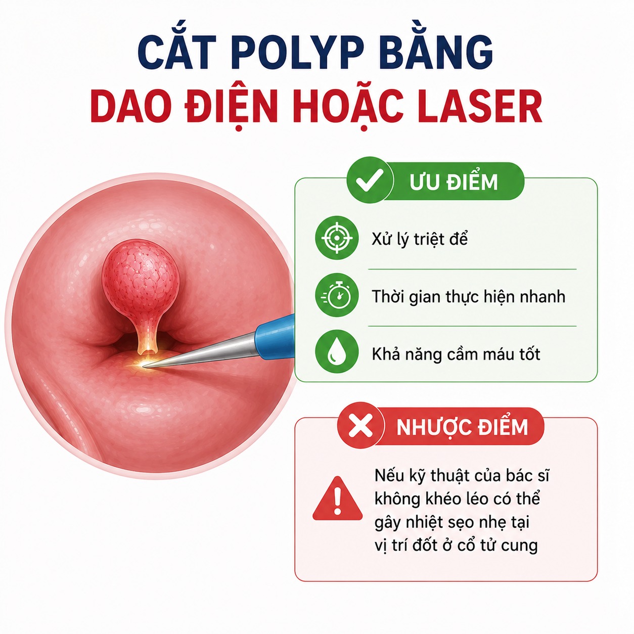 Bóc polyp tử cung Cắt polyp bằng dao điện hoặc Laser