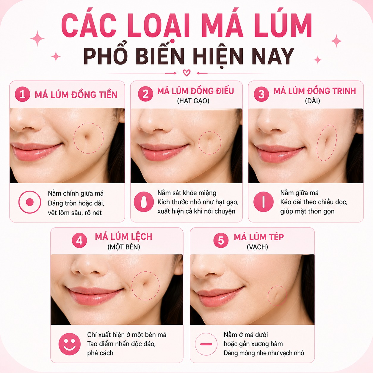 Các loại má lúm phổ biến hiện nay