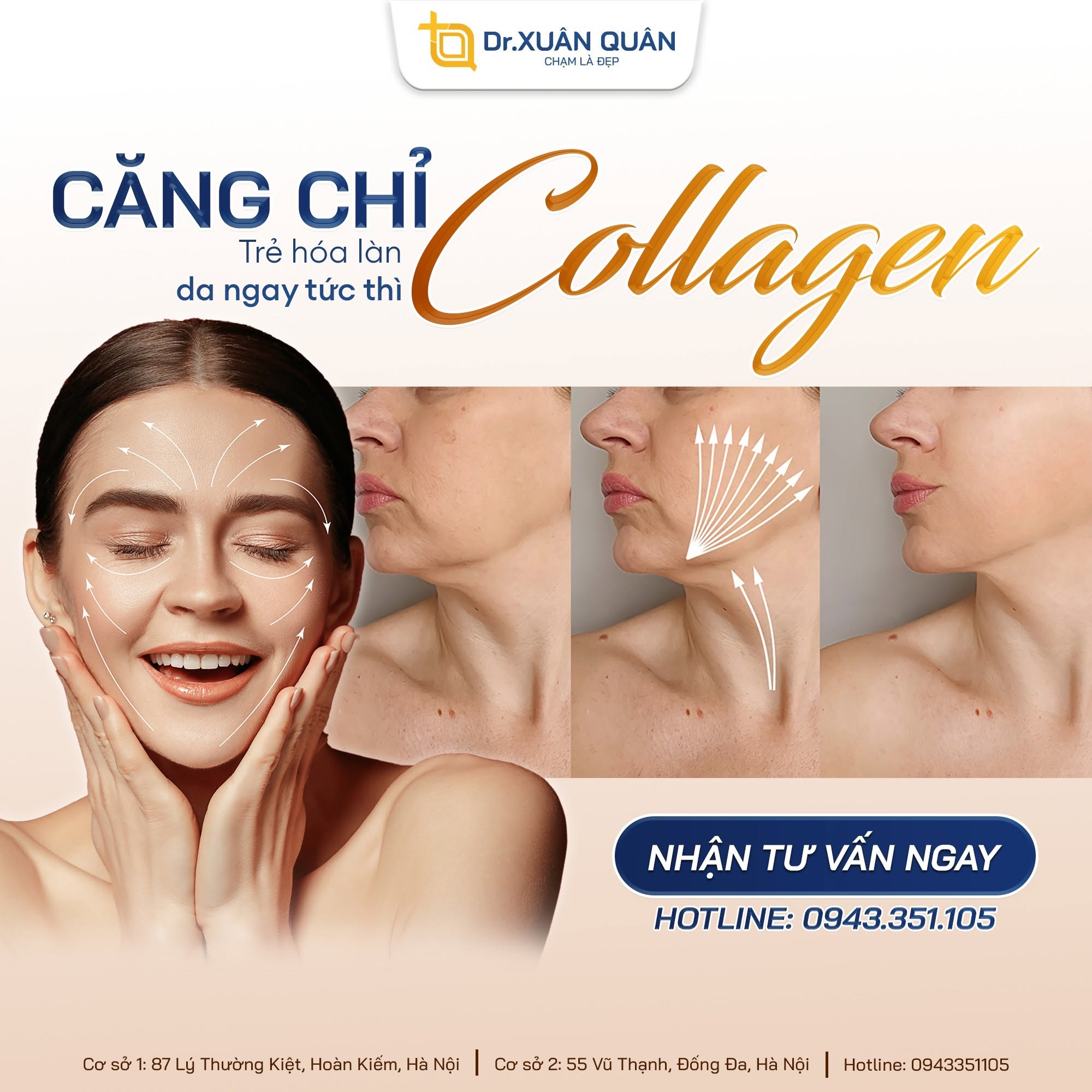 Hình ảnh căng chỉ collagen tại Thẩm mỹ Dr Xuân Quân