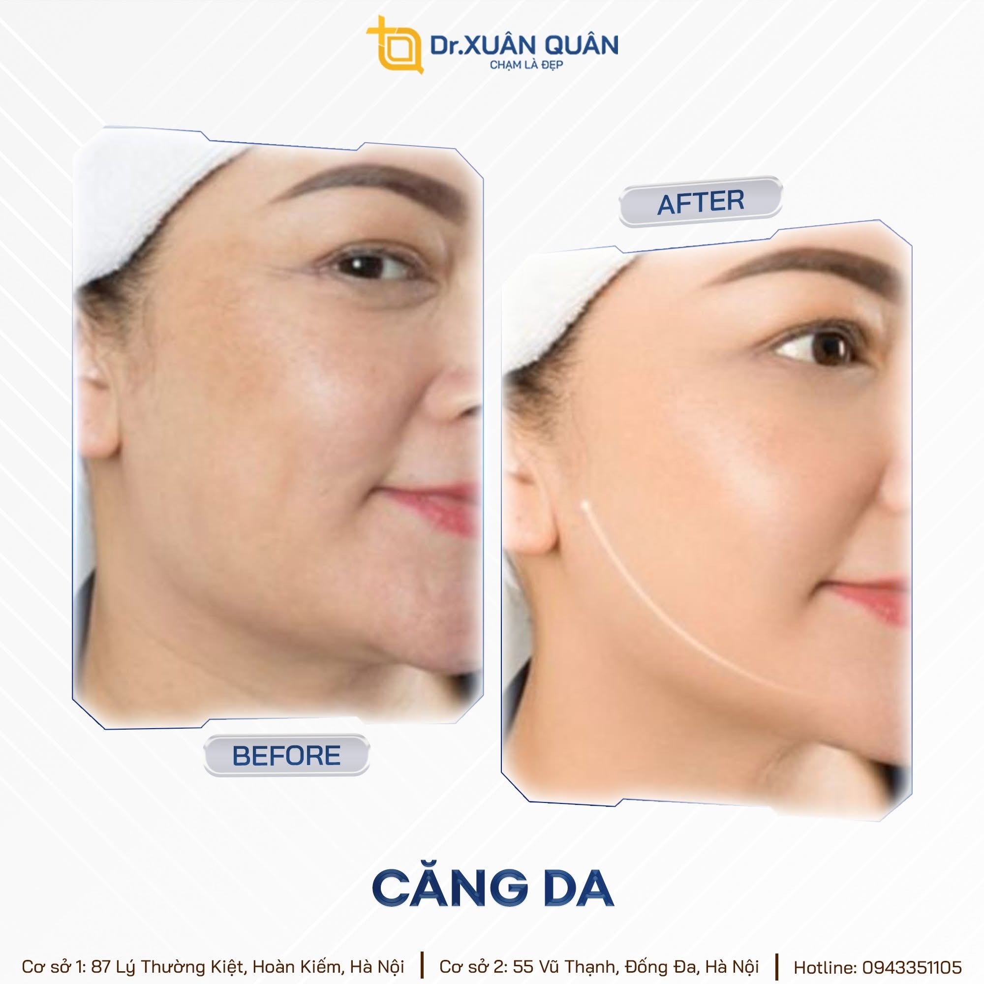 Hình ảnh trước và sau khi căng da mặt tại Thẩm mỹ Dr Xuân Quân