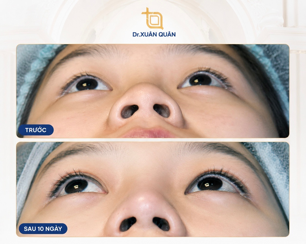 Cắt cánh mũi và cuộn cánh mũi: Nên chọn phương pháp nào? Trực tiếp thực hiện bởi Bác sĩ Xuân Quân