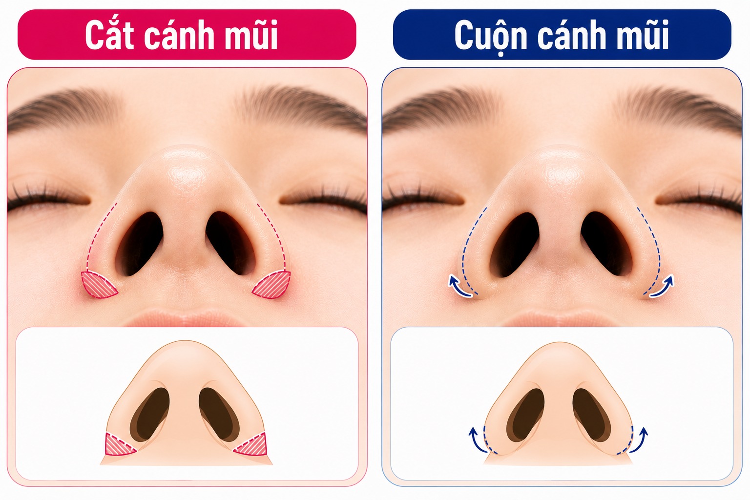 Phân biệt cắt cánh mũi và cuộn cánh mũi
