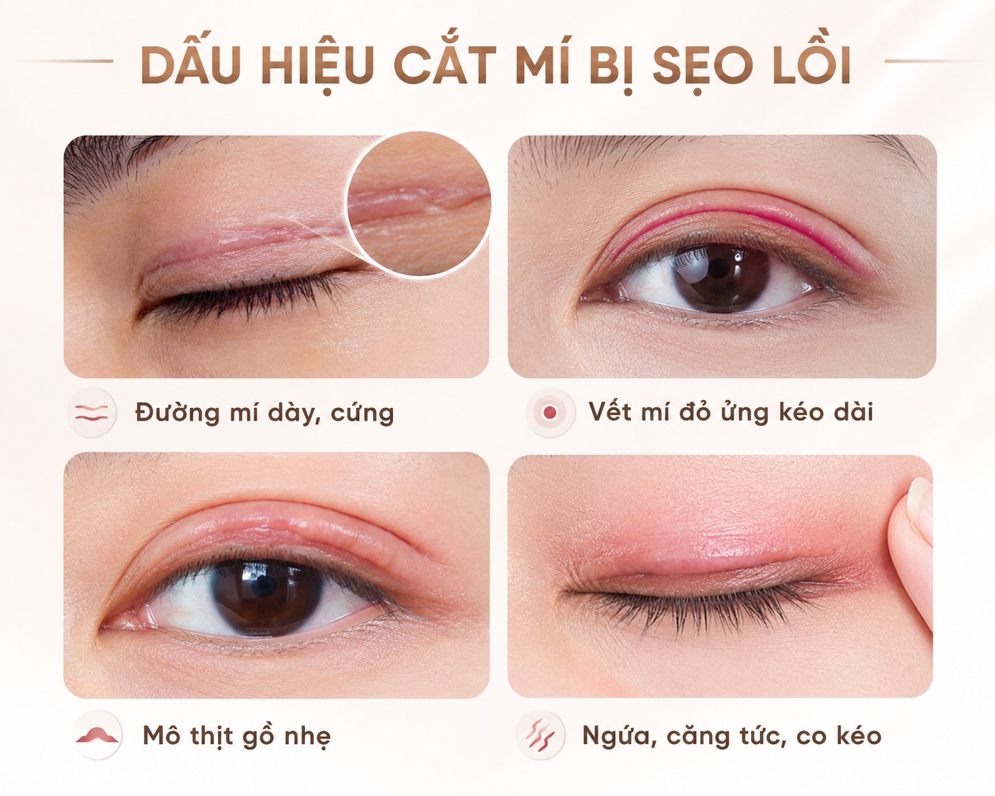 Cắt mí bị sẹo lồi có sửa được không? Nguyên nhân và hướng xử lý Dấu hiệu nhận biết cắt mí bị sẹo lồi sớm
