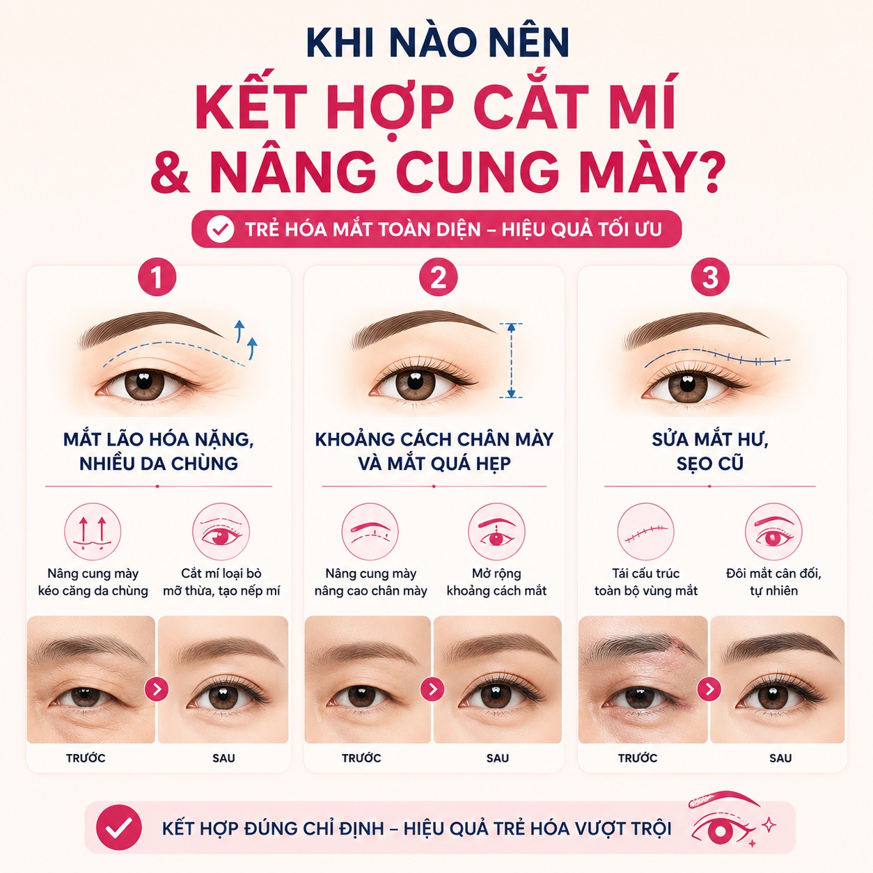 Có trường hợp nào nên kết hợp cắt mí và nâng cung mày không?