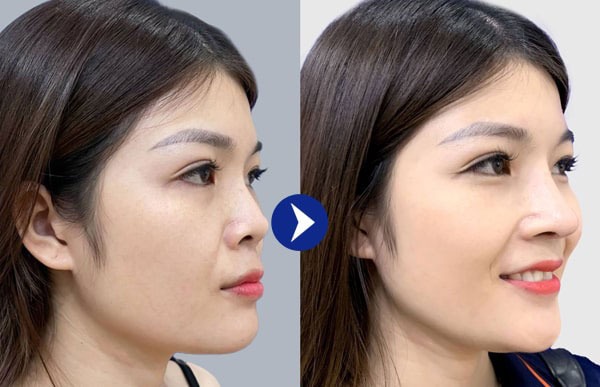 Thẩm mỹ Dr. Xuân Quân – địa chỉ nâng mũi uy tín tại Hà Nội được khách hàng đánh giá cao Chứng thực từ khách hàng