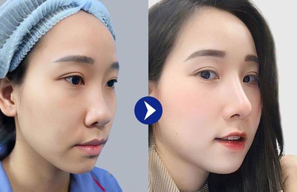 Thẩm mỹ Dr. Xuân Quân – địa chỉ nâng mũi uy tín tại Hà Nội được khách hàng đánh giá cao Khách hàng tin tưởng Thẩm mỹ Dr. Xuân Quân