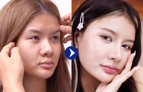 Thẩm mỹ Dr. Xuân Quân – địa chỉ nâng mũi uy tín tại Hà Nội được khách hàng đánh giá cao Hình ảnh thực tế khách hàng nâng mũi