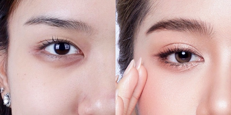 Mắt mí lót hay 2 mí đẹp hơn?