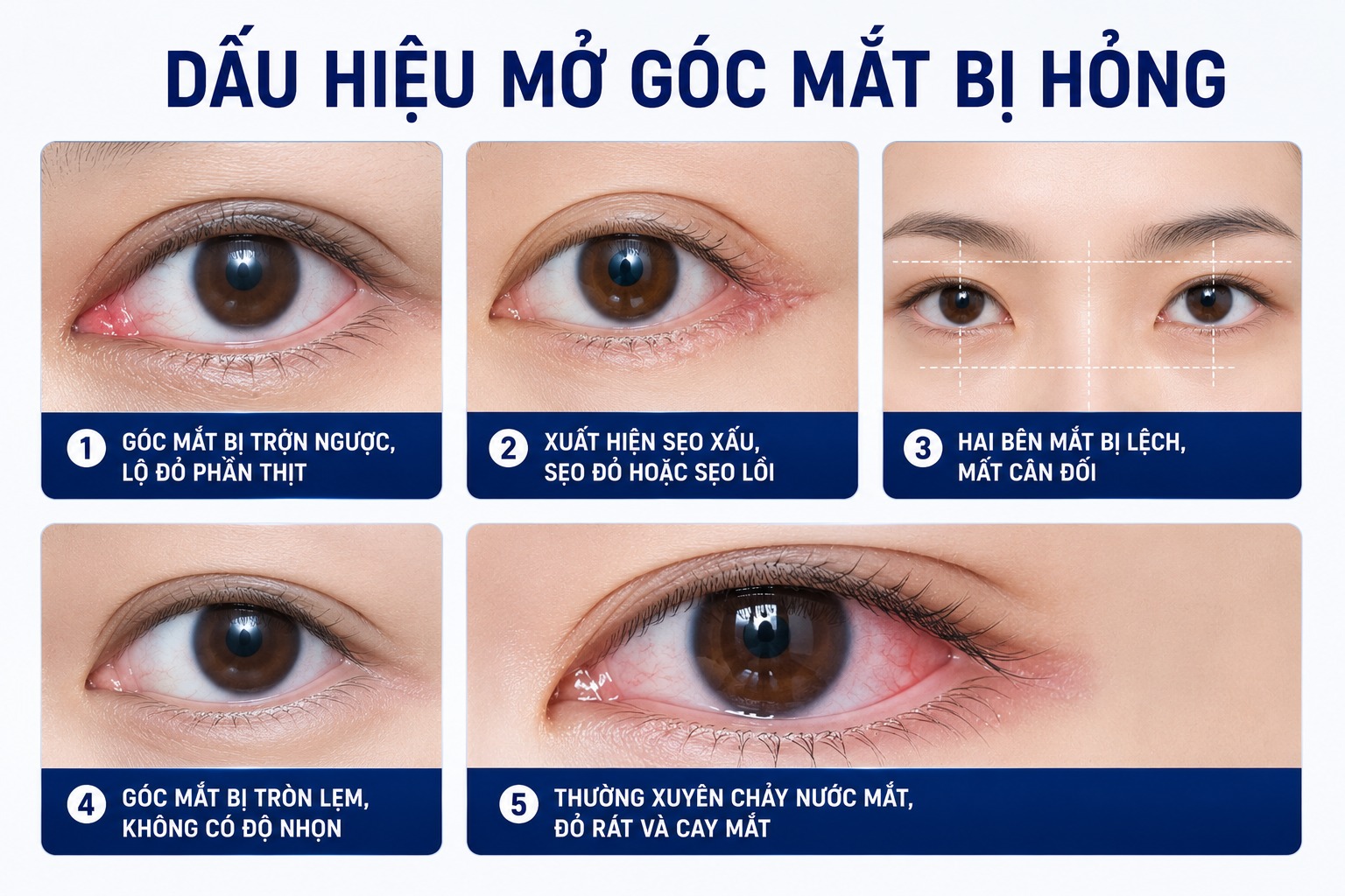 Mở góc mắt bị hỏng có sửa được không? Chi phí bao nhiêu? Dấu hiệu mở góc mắt bị hỏng phổ biến