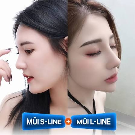 Phân biệt mũi S line và L line: Dáng mũi nào phù hợp với bạn? Thẩm mỹ Dr Xuân Quân là địa chỉ uy tín cho mọi người