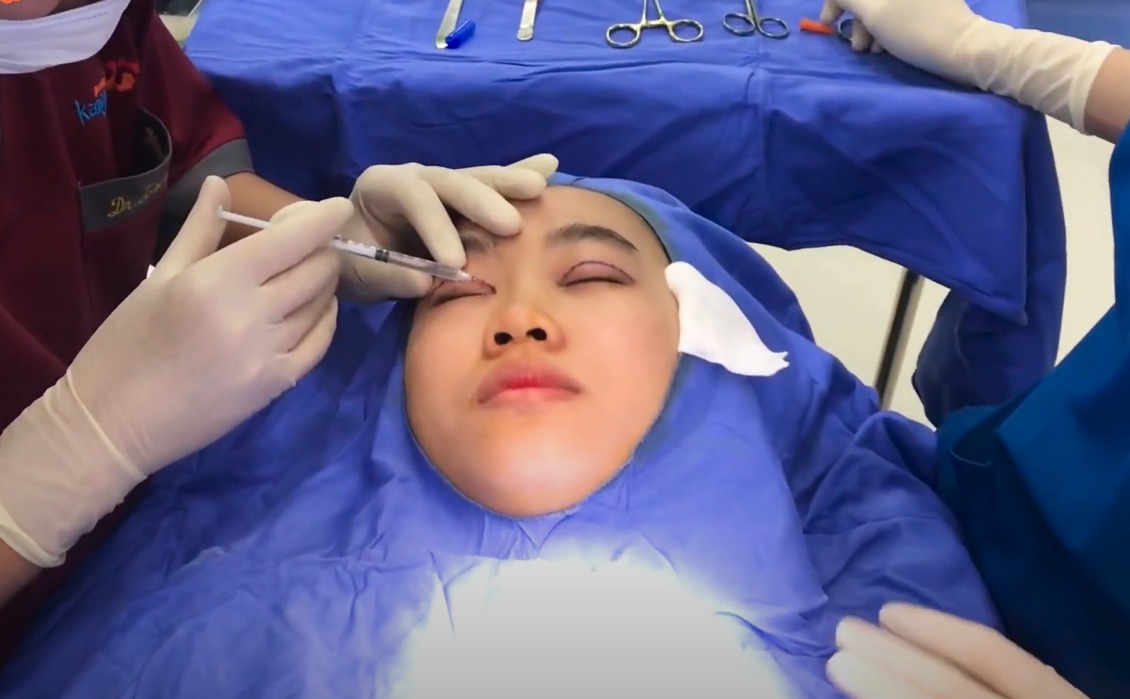 Nhấn mí xong bị ngứa khi nào cần gặp bác sĩ?