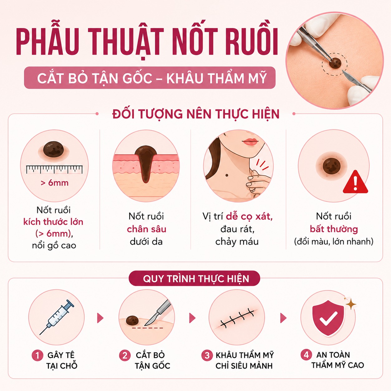 Đối tượng nên thực hiện phẫu thuật nốt ruồi
