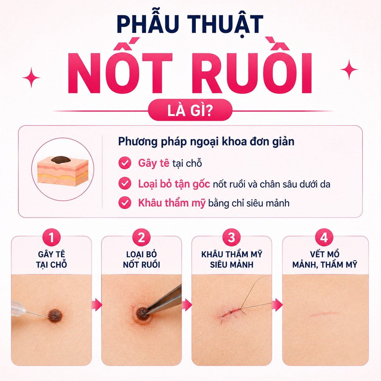 Phẫu thuật nốt ruồi là gì?