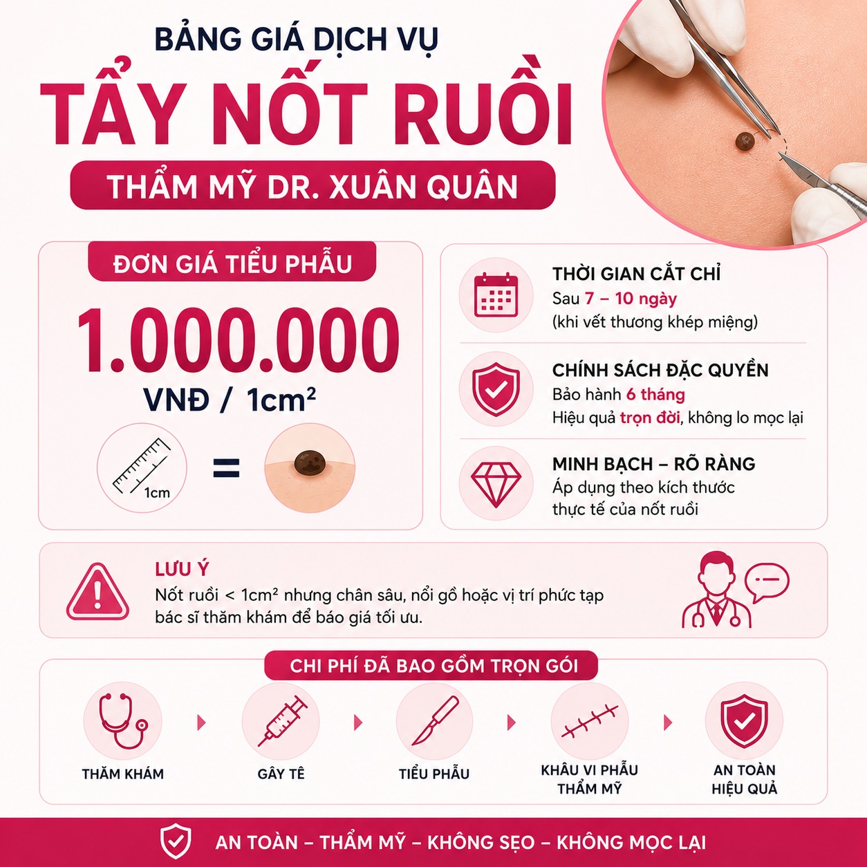 Tẩy mụn ruồi bao nhiêu tiền? Bảng giá dịch vụ tẩy nốt ruồi tại Thẩm mỹ Dr Xuân Quân