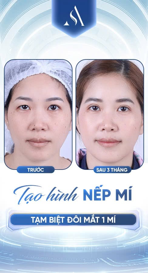 Bác sĩ cắt mí đẹp tại Hà Nội: Tại sao chọn Thẩm mỹ Dr. Xuân Quân? Khách hàng cắt mĩ tại Thẩm mỹ Dr. Xuân Quân