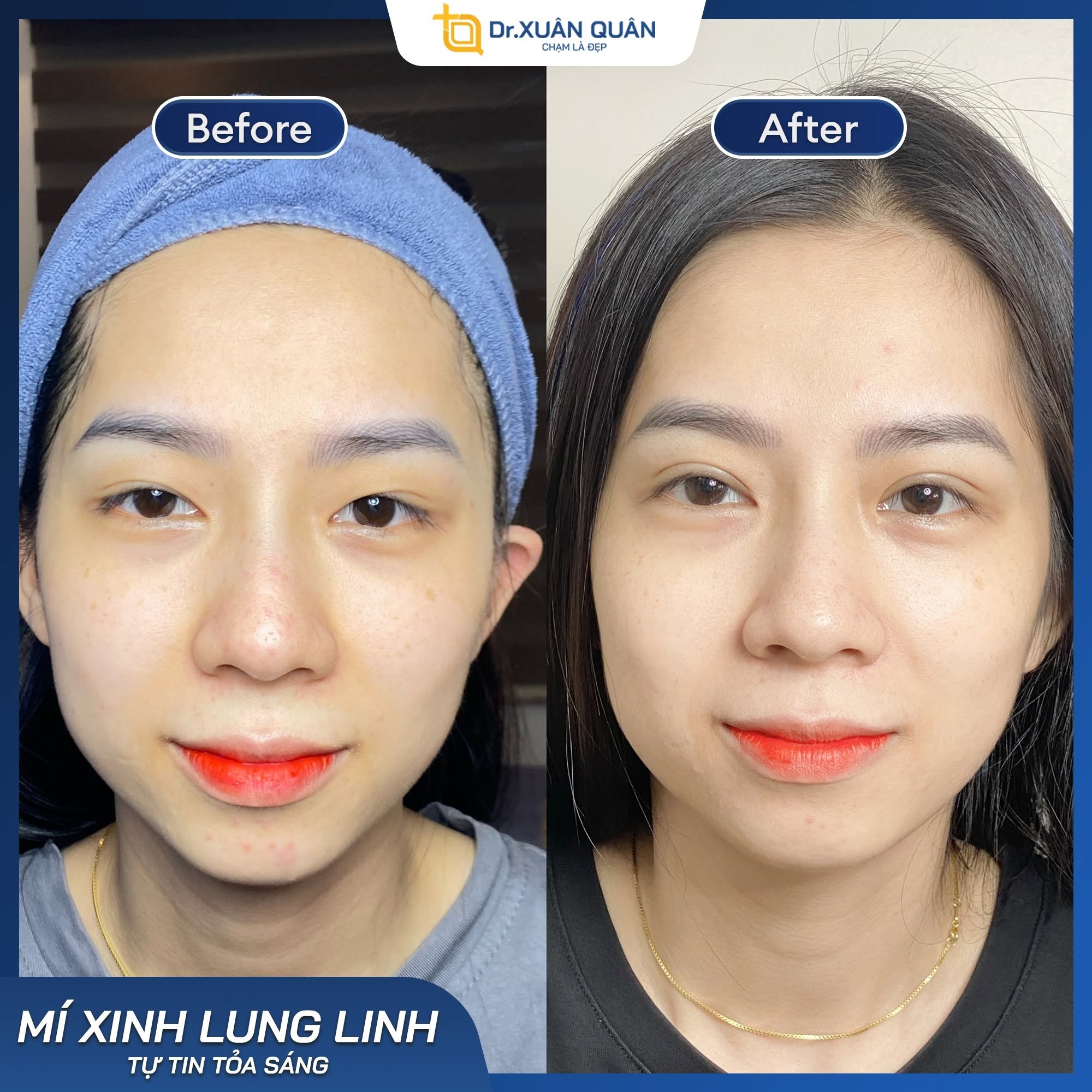 Bác sĩ cắt mí đẹp tại Hà Nội: Tại sao chọn Thẩm mỹ Dr. Xuân Quân? Hình ảnh cắt mí thực tế do bác sĩ Xuân Quân thực hiện