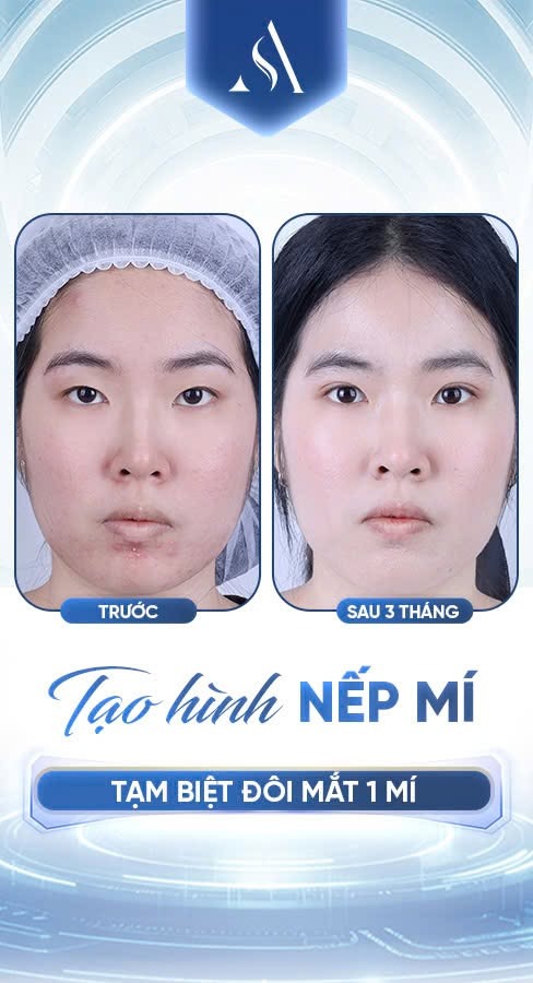 Nên bấm mí hay cắt mí? Lựa chọn nào an toàn, giữ được lâu dài? Tạo hình nếp mí sau 3 tháng