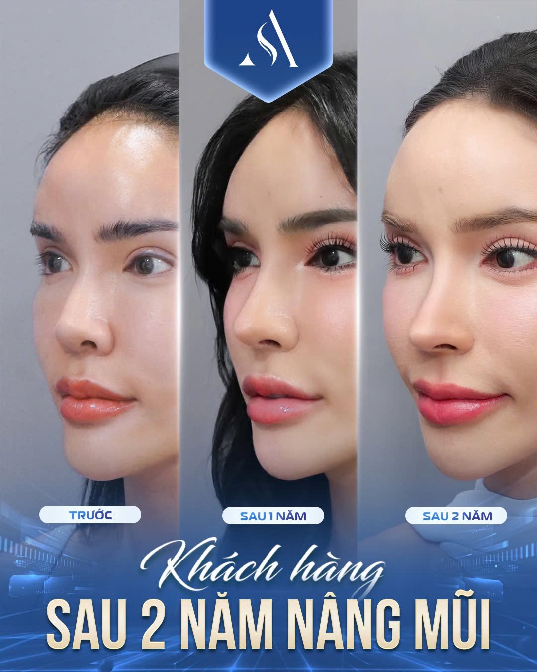 Khách hàng sau 2 năm nâng mũi tại Thẩm mỹ Dr. Xuân Quân