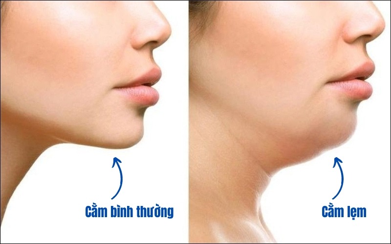 Cằm lẹm là sao? Nguyên nhân và dấu hiệu nhận biết