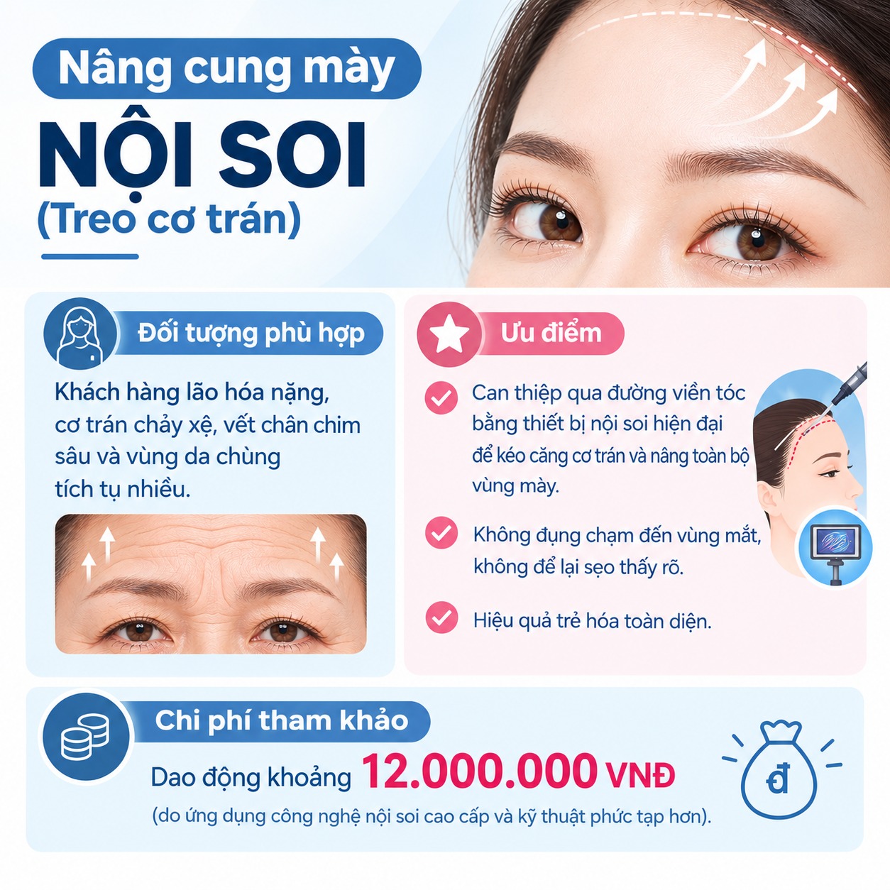 Nâng cung mày nội soi (Treo cơ trán)