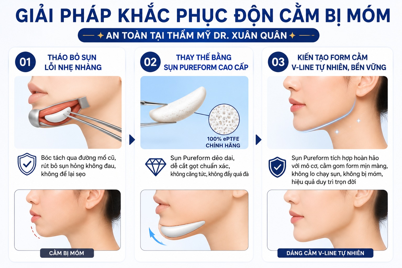 Giải pháp khắc phục độn cằm bị móm an toàn tại Thẩm mỹ Dr Xuân Quân