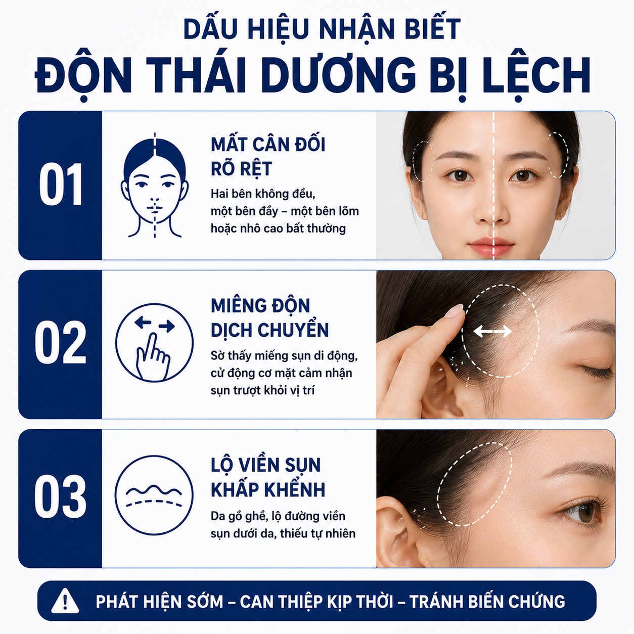 Độn thái dương bị lệch phải làm sao? Hướng dẫn cách xử lý triệt để Dấu hiệu nhận biết độn thái dương bị lệch