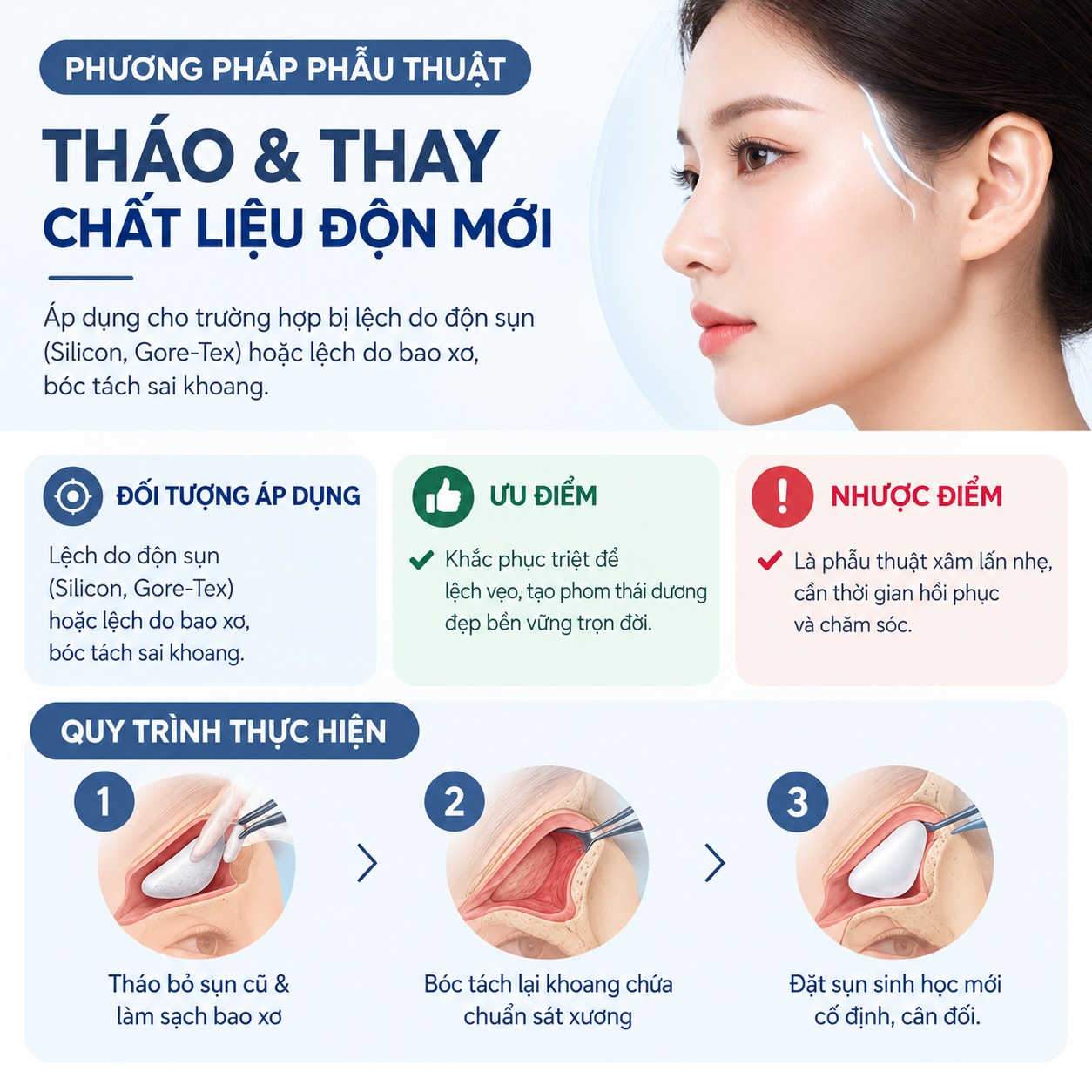 Độn thái dương bị lệch phải làm sao? Hướng dẫn cách xử lý triệt để Phương pháp phẫu thuật tháo & thay chất liệu độn mới
