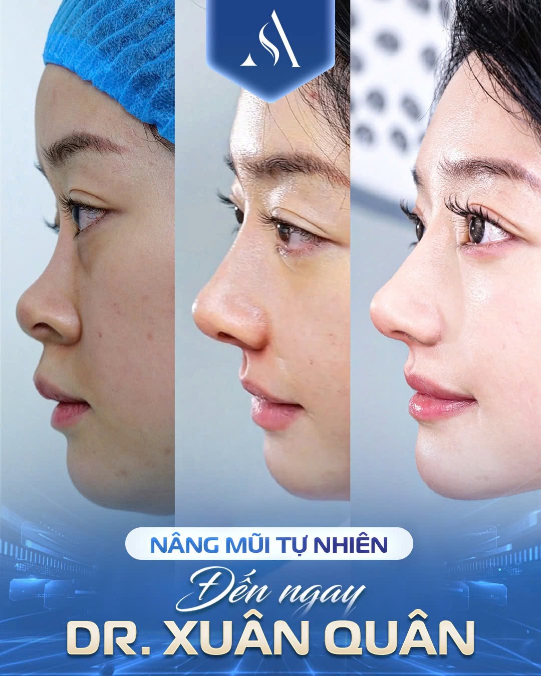 Nâng mũi tự nhiên tại Thẩm mỹ Dr. Xuân Quân