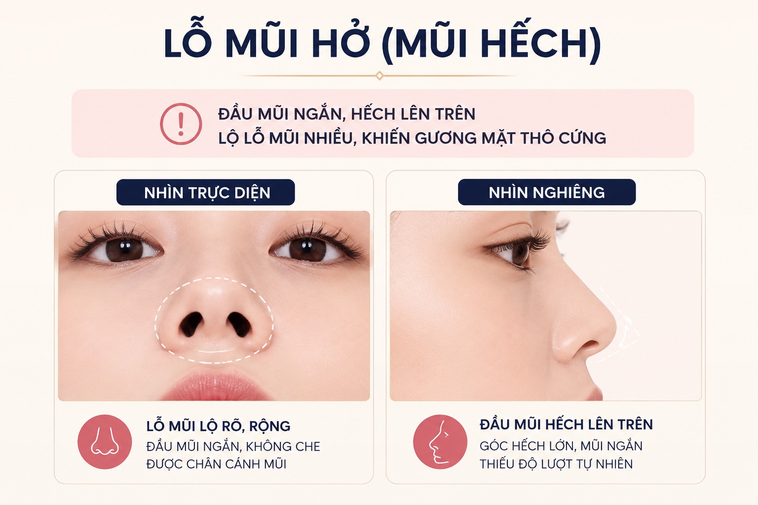 Lỗ mũi hở là gì? Đặc điểm nhận diện