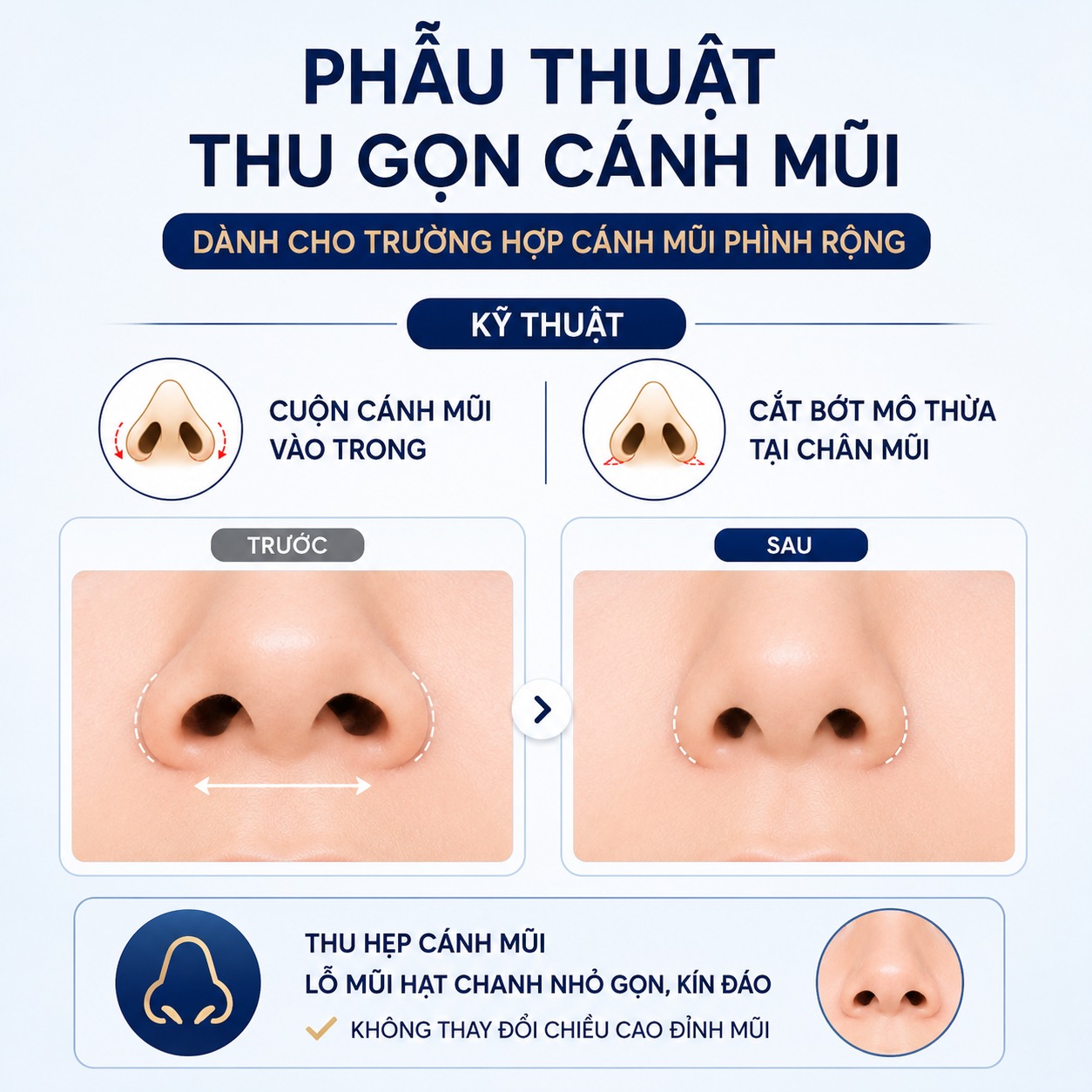 Lỗ mũi hở có sửa được không? Bí quyết sở hữu dáng mũi kín, chuẩn đẹp Phẫu thuật thu gọn cánh mũi