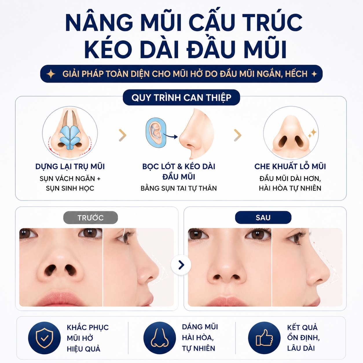 Lỗ mũi hở có sửa được không? Bí quyết sở hữu dáng mũi kín, chuẩn đẹp Nâng mũi cấu trúc kéo dài đầu mũi