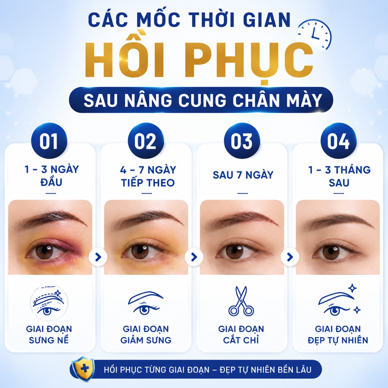 Nâng cung chân mày bị sưng có sao không? Khi nào cần gặp bác sĩ? Các mốc thời gian hồi phục sau nâng cung chân mày