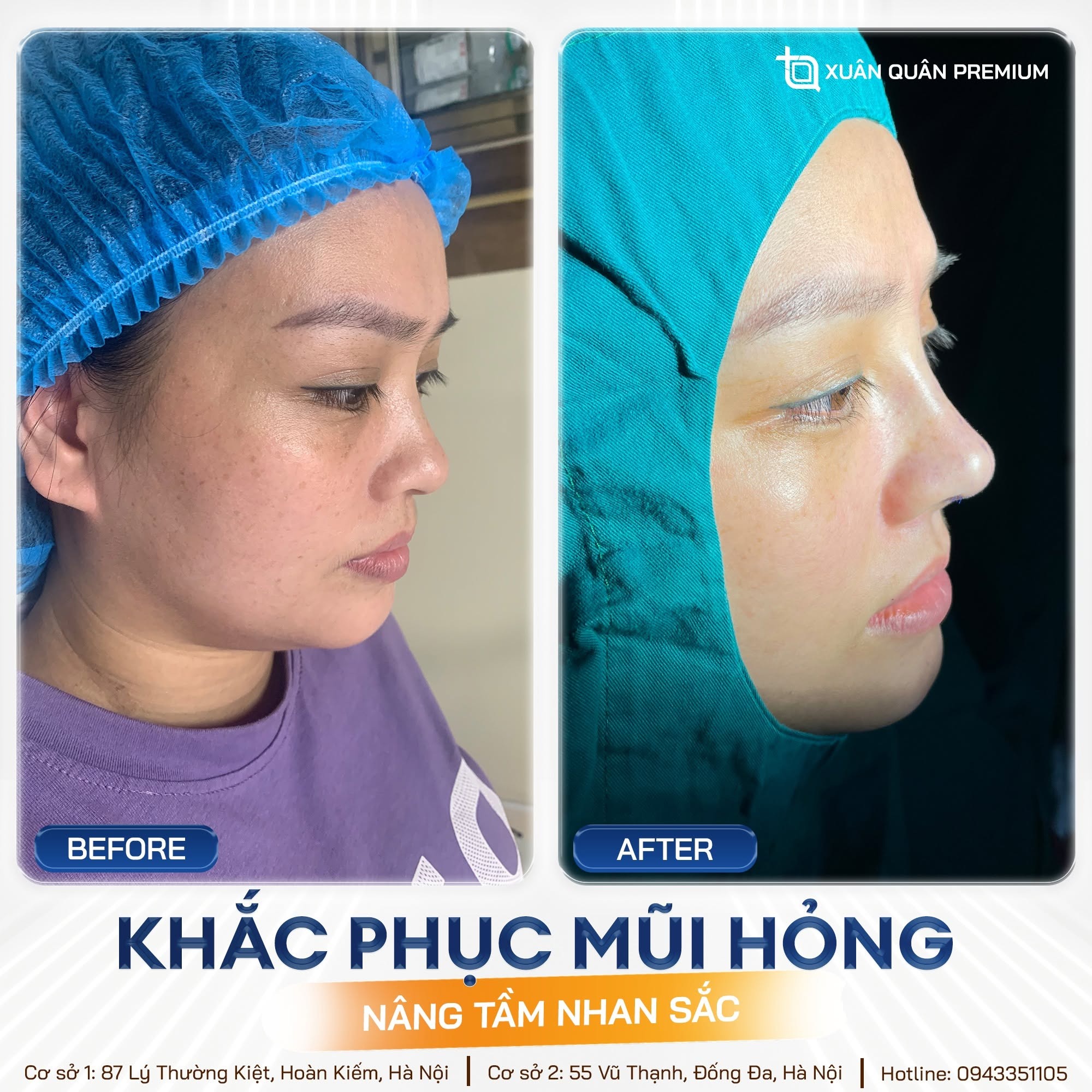 Chỉnh lại mũi bị hỏng tại Thẩm mỹ Dr. Xuân Quân