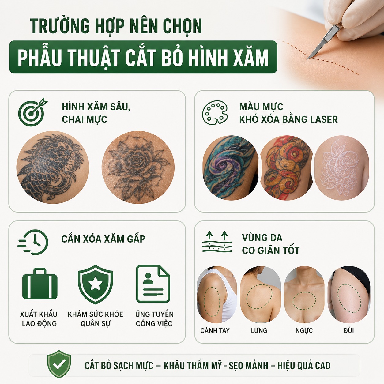 Trường hợp nên chọn phẫu thuật cắt bỏ hình xăm